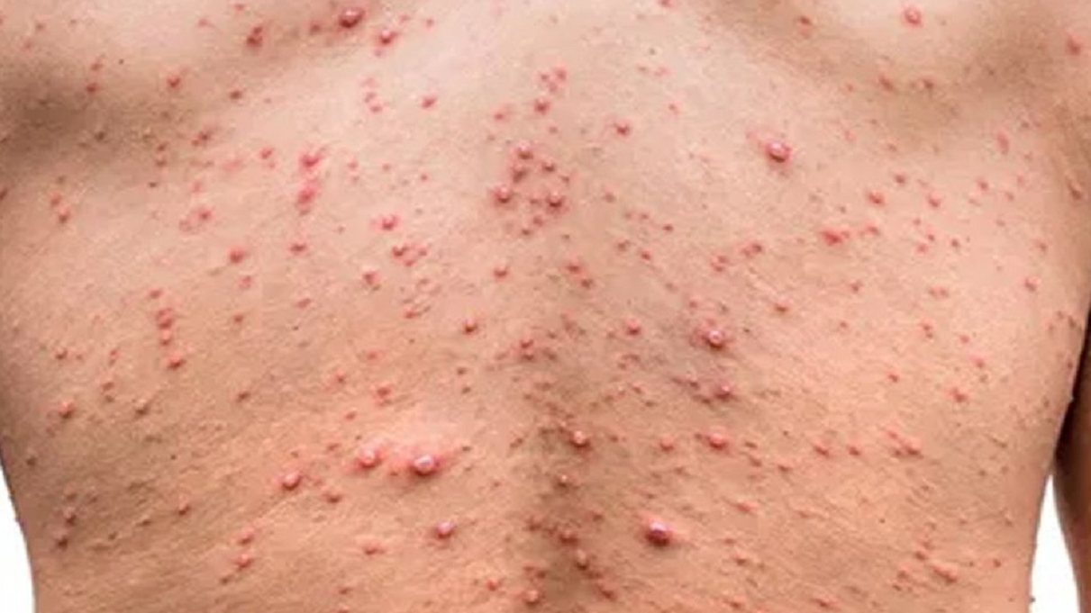 منظمة الصحة العالمية تعلن حالة الطوارئ الصحية بعد الإنتشار المخيف ل