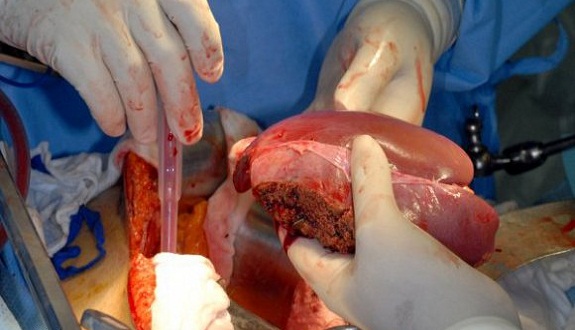 في أقل من 48 ساعة.. نجاح عمليتي زراعة للكبد بالمستشفى الجامعي ابن سينا بالرباط