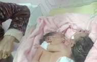 مستشفى الحسن الثاني بفاس يشهد ولادة توأم سيامي ملتصق بقلب واحد