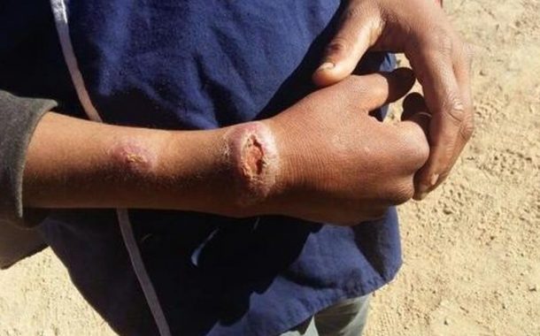 وزارة التربية الوطنية والتعليم الأولي والرياضة تُوضِّح بعد إصابة تلاميذ بداء الليشمانيا بتيزنيت