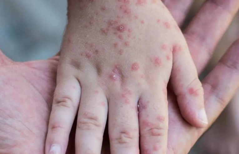 المؤسسات التعليمية بالمغرب تحث الأسر على تلقيح أبنائها ضد 